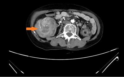 Case report: An adult intussusception caused by ascending colon cancer